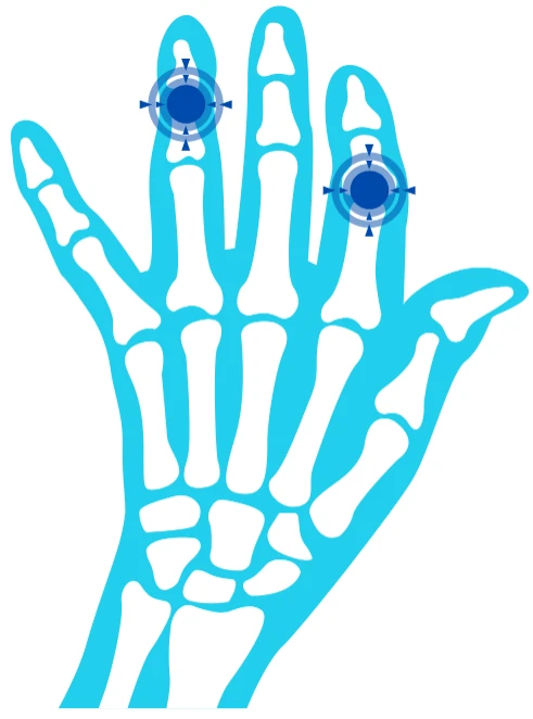 Maladies des Os.webp